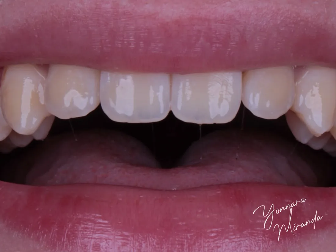 Clareamento dental, foto 1: antes do tratamento
