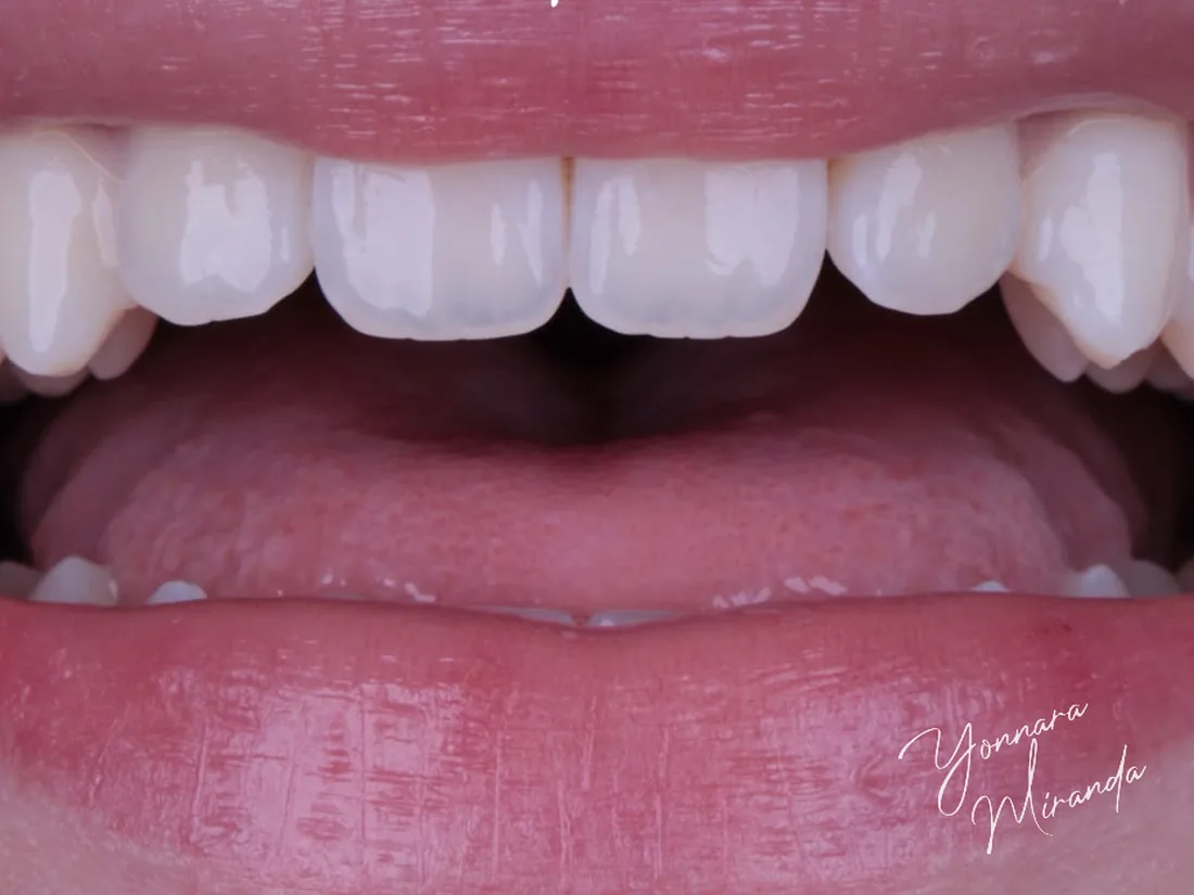 Clareamento dental, foto 1: depois do tratamento