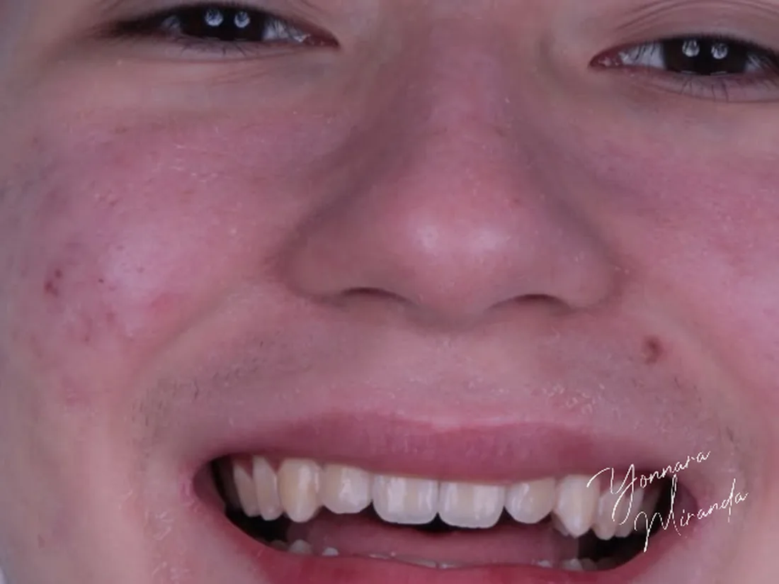 Clareamento dental, foto 2: antes do tratamento