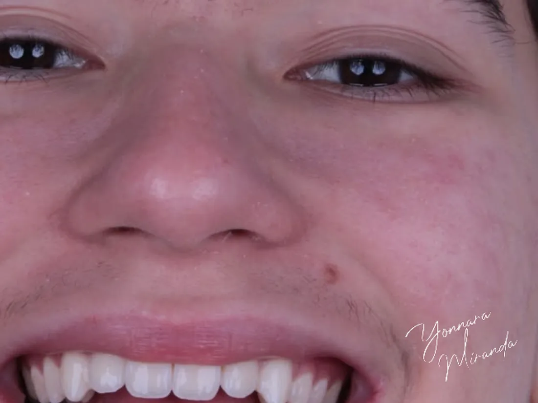 Clareamento dental, foto 2: depois do tratamento