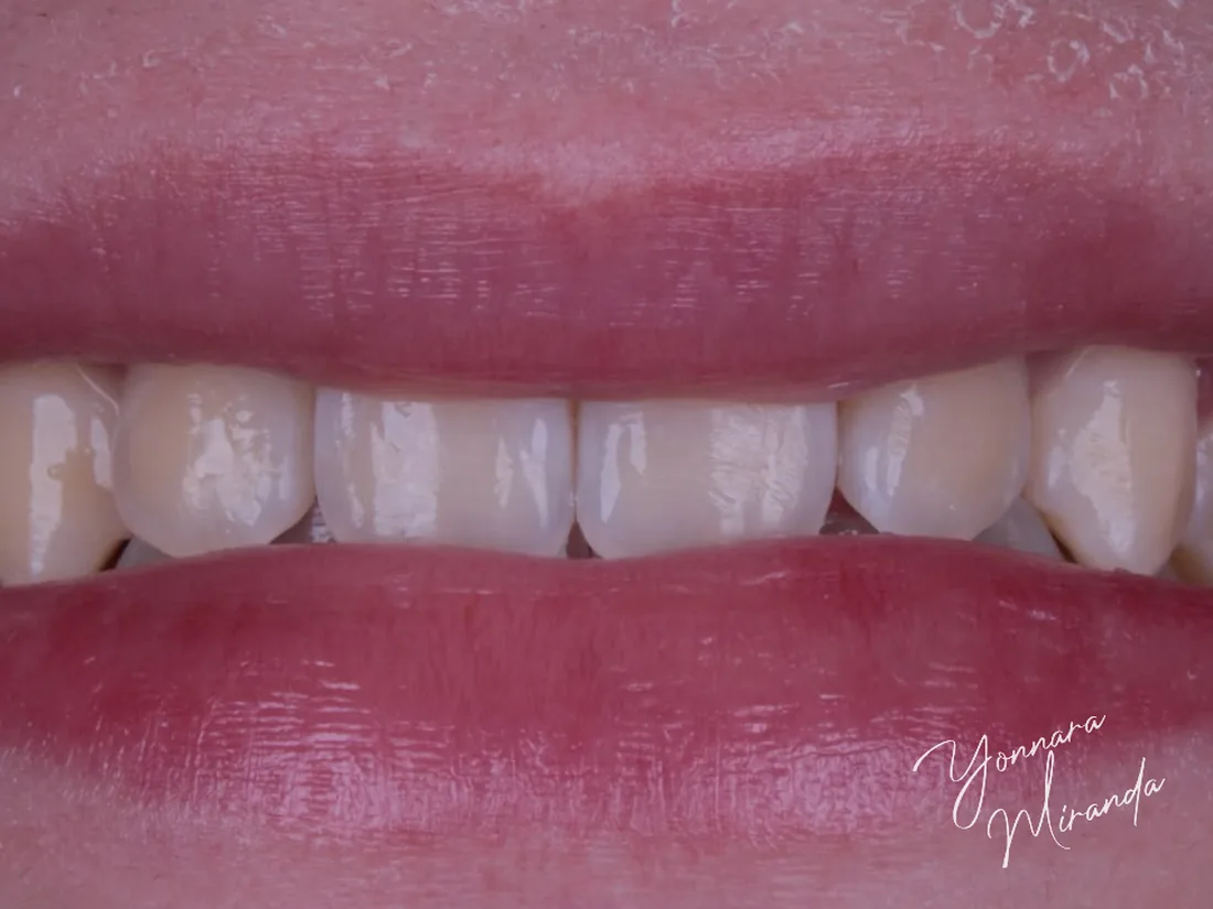 Clareamento dental, foto 3: antes do tratamento