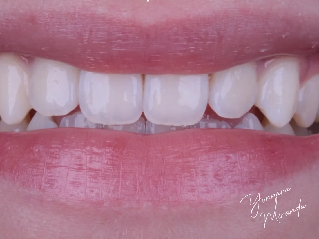 Clareamento dental, foto 3: depois do tratamento