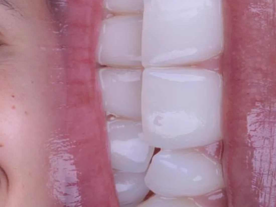 Clareamento dental, foto 2: depois do tratamento