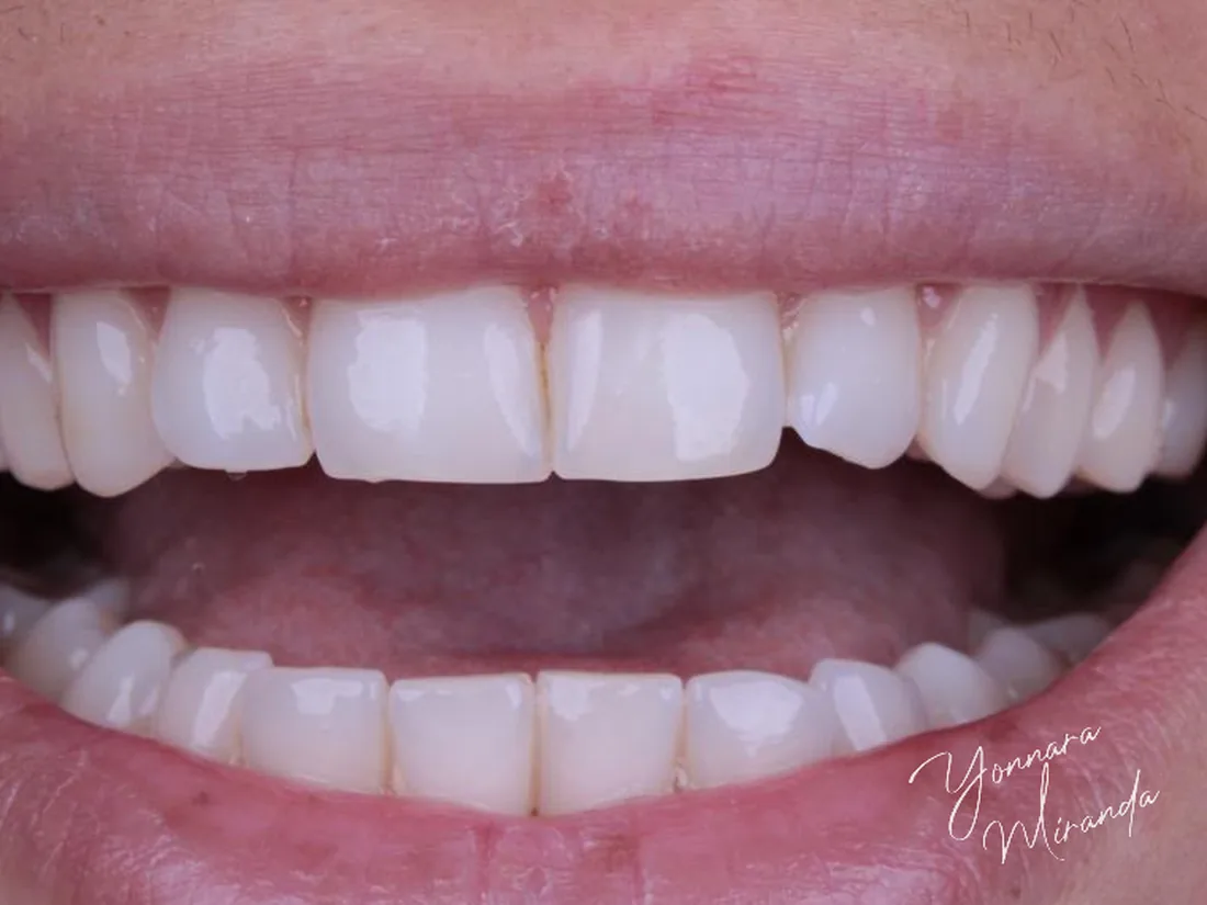 Clareamento dental, foto 3: antes do tratamento