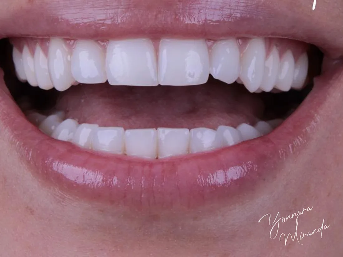 Clareamento dental, foto 3: depois do tratamento