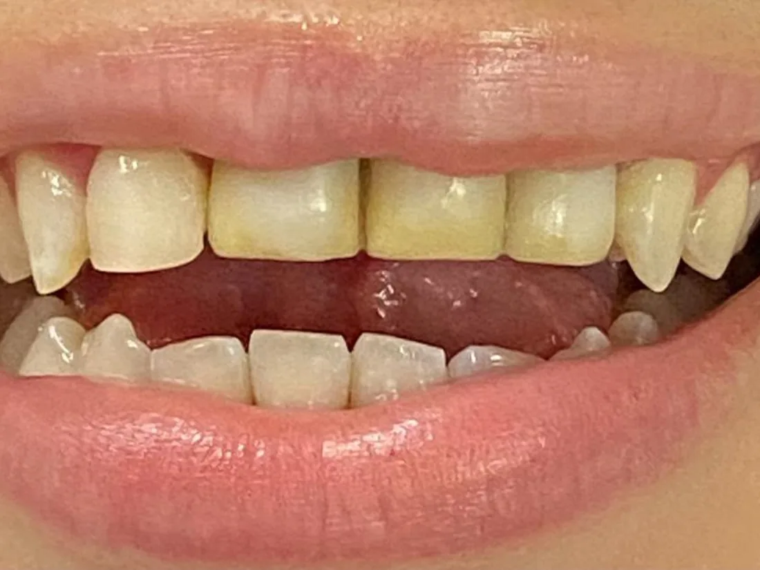 Lentes em porcelana, foto 1: antes do tratamento