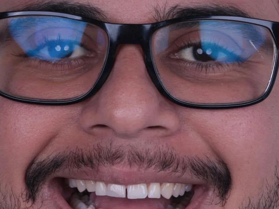 Lentes em resina, foto 1: antes do tratamento