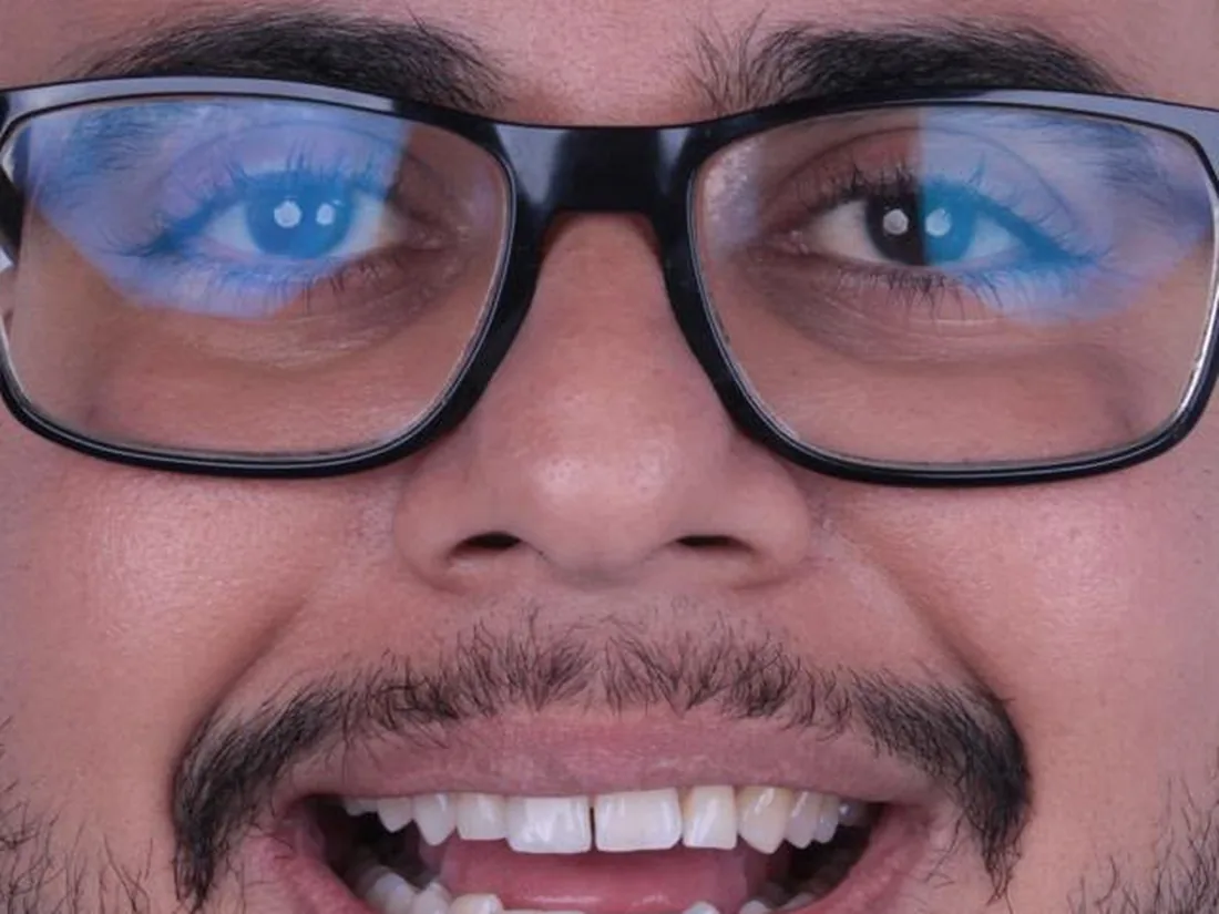 Lentes em resina, foto 1: depois do tratamento